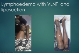 snapshot of the healing progress of a lymhoedema patient who underwent surgery